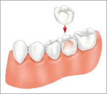 Cure Dentali Corone
