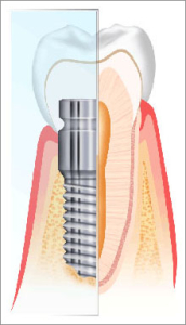 Cure Dentali Impianti