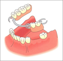 Cure Dentali La protesi parziale