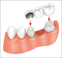 Cure Dentali Ponte